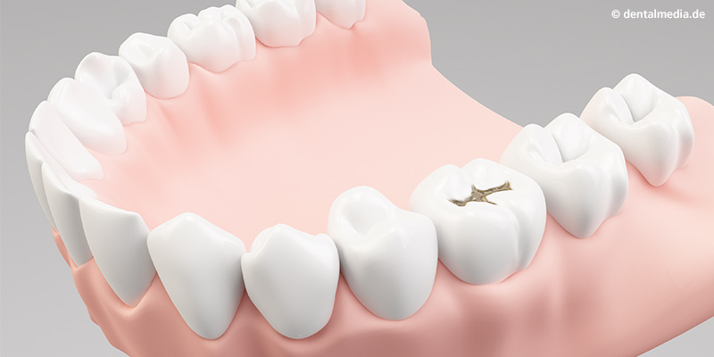 Inlays : Durch Karies geschädigter Zahn